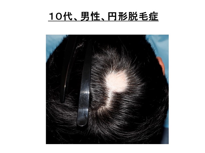 円形脱毛症　病院